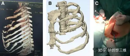 3d打印机改善肋骨骨折手术的可行性研究