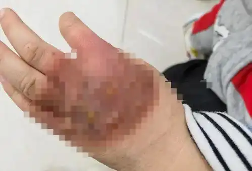 孩子被老师单独带走教育后深度烫伤,校方回应涉事老师已辞退