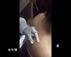 广州女子私密部位整形术后流血不止