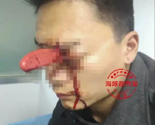 厉害男子头插水果刀,淡定排队就诊,原来萧山也曾有类似事情