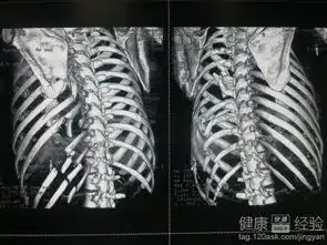 肋骨骨折的临床表现