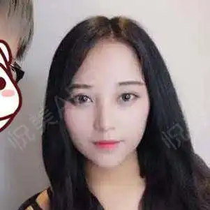 千年的美瞳小妖精今天也栽秧了早上出门快迟到,...眼综合悦美整形