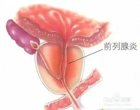 男人必知前列腺炎的自我保养方法