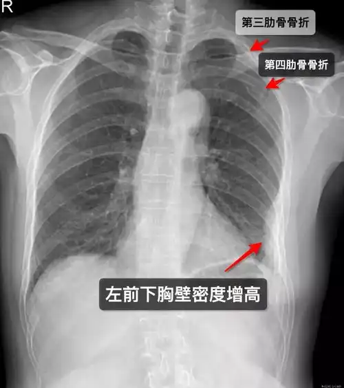 那些年,你漏诊过的肋骨骨折