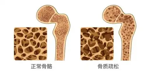 为何老年人使用呼吸机后出现肋骨骨折医学原因解析