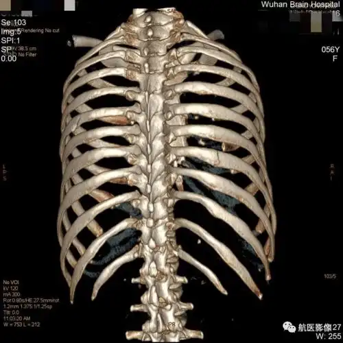 为什么肋骨骨折ct扫描一定要做三维成像
